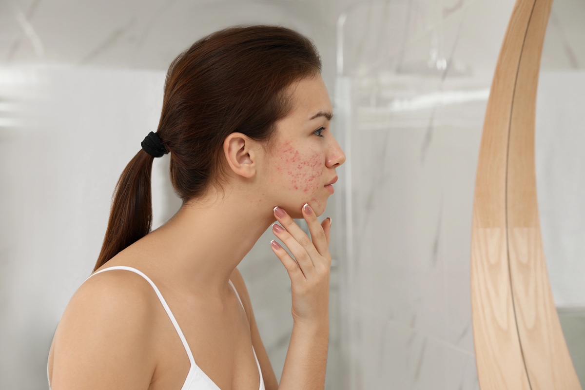 You are currently viewing Pielęgnacja skóry z trądzikiem różowatym