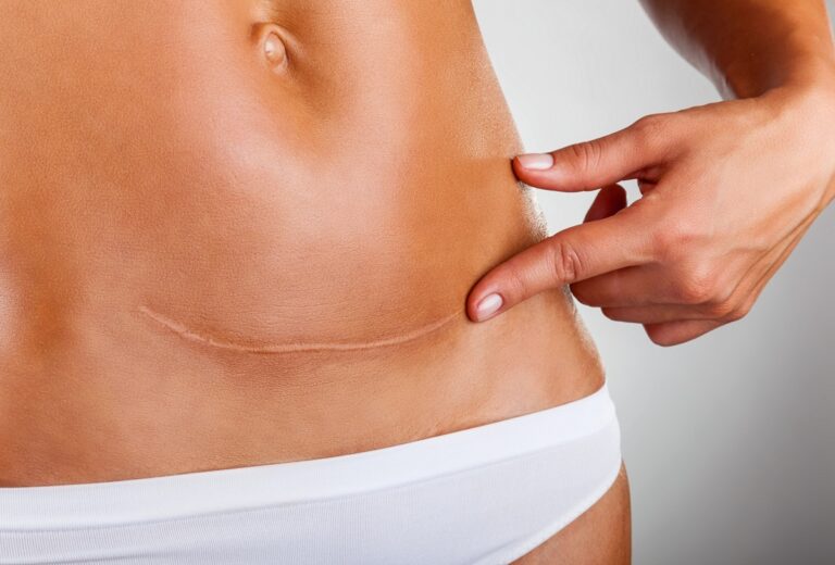 Read more about the article „Cesarzowa wszelkich blizn”. Co mówi o nas blizna po cesarskim cięciu? Rozmowa z Katarzyną Derks