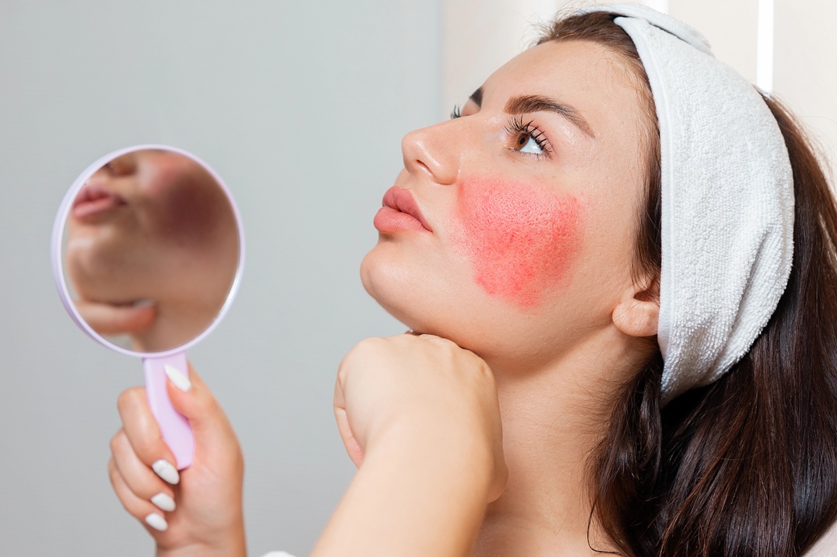 You are currently viewing Rumień na twarzy: dlaczego się pojawia i jak skutecznie go łagodzić? Poradnik kosmetologa